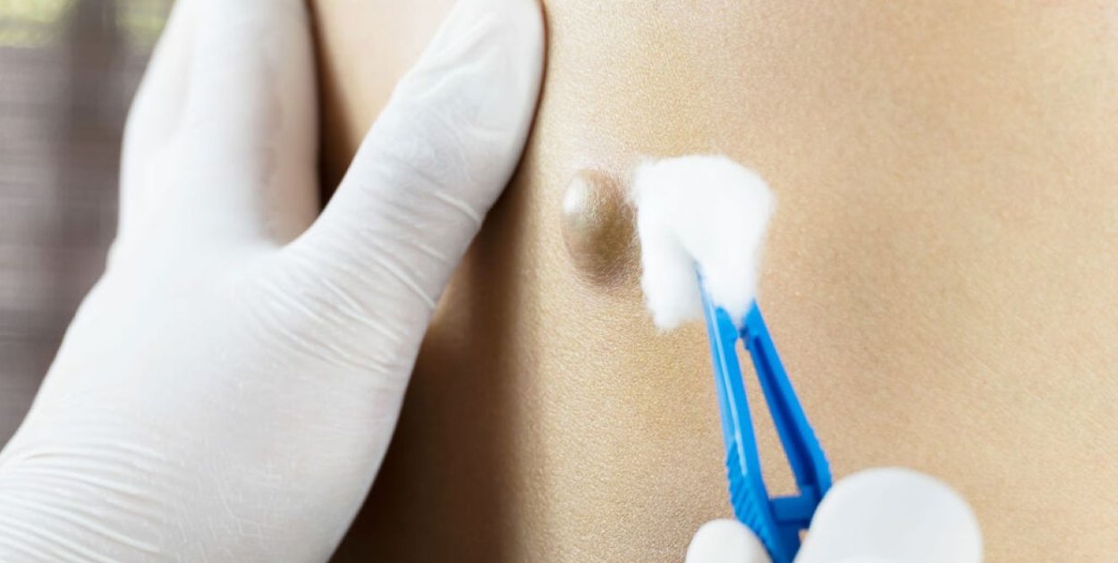 Torbiel włosowa – wpływ na codzienne funkcjonowanie i możliwości leczenia